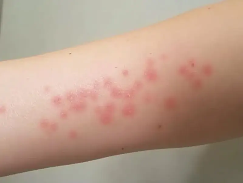 Alergia na lateks: objawy, rodzaje reakcji i postępowanie w anafilaksji. Kiedy uczulenie na gumę staje się śmiertelnie niebezpieczne?